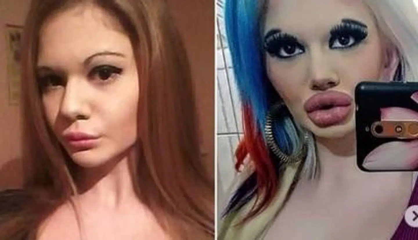 Andrea Ivanova før og efter injektionerne.