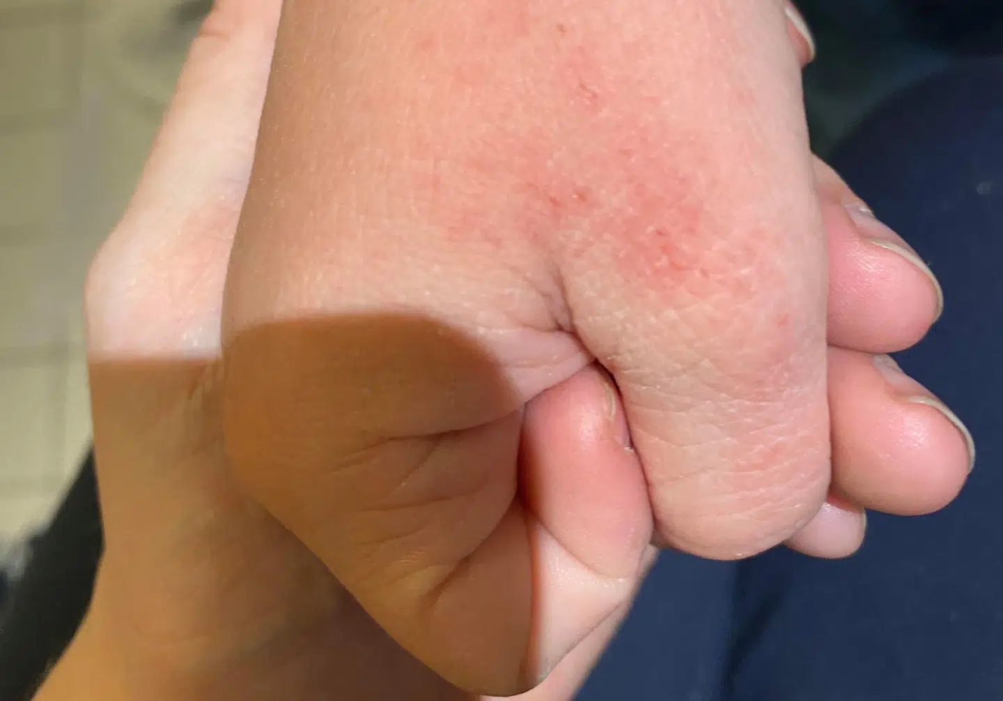 Noahs hud bliver rød og irriteret af konstant at vaske hænder. Det gør ondt på ham, fortæller hans mor.