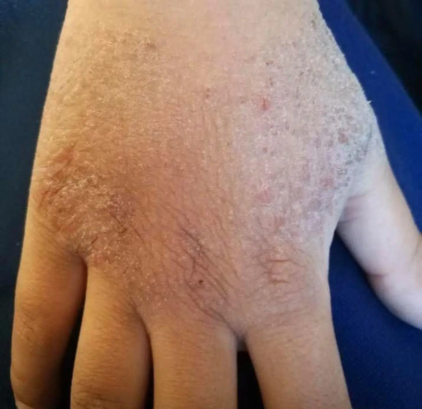 Efter blot to dage i skole er Benjamins hånd helt tørret ud.