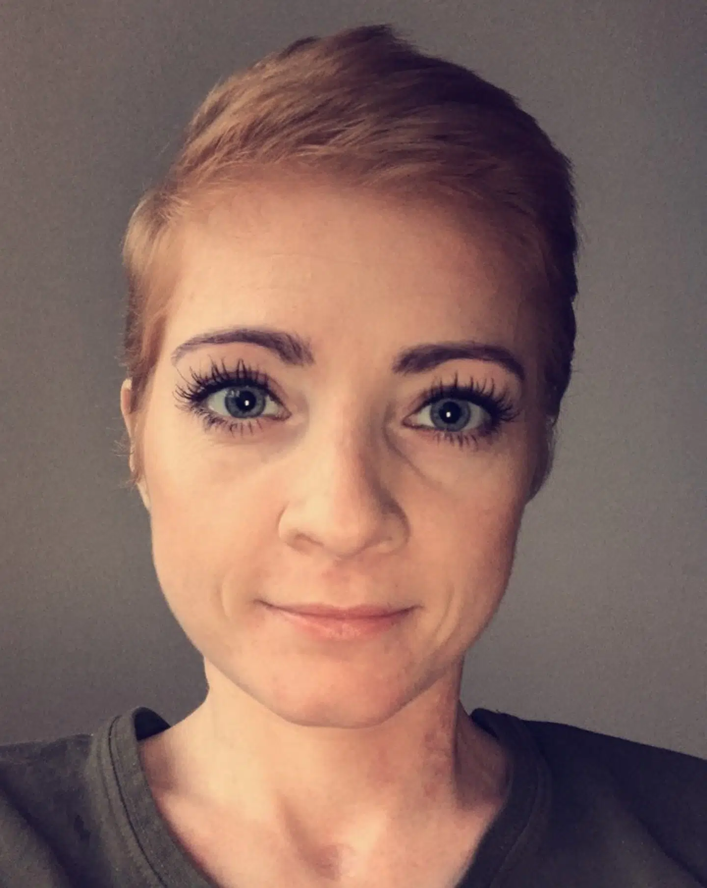 Sigrun Johannesdottir Bisp er 30 år og har to gange fået en lungetransplantation.