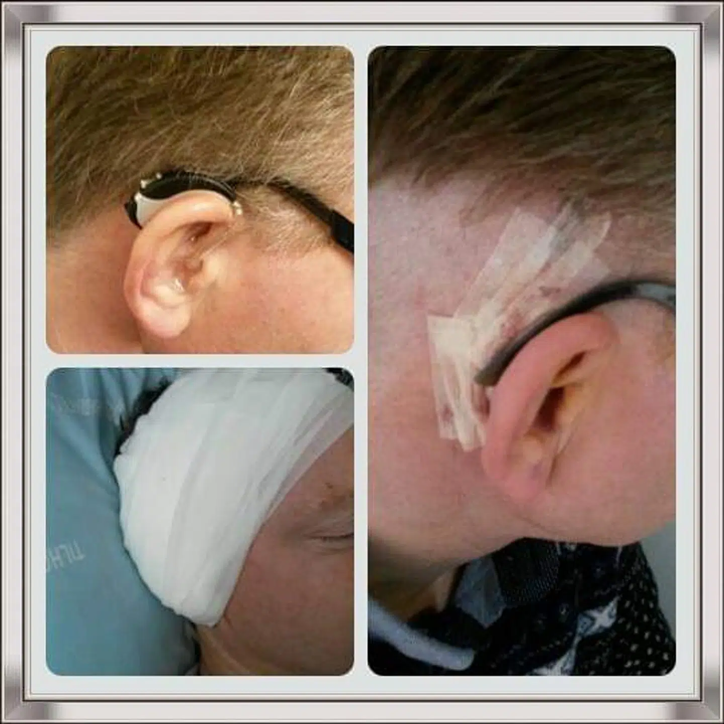 Erik Thonke kort efter han i 2010 fik opereret et såkaldt cocklear-implantat ind i kraniet. Implantatet har givet ham hørelsen tilbage.