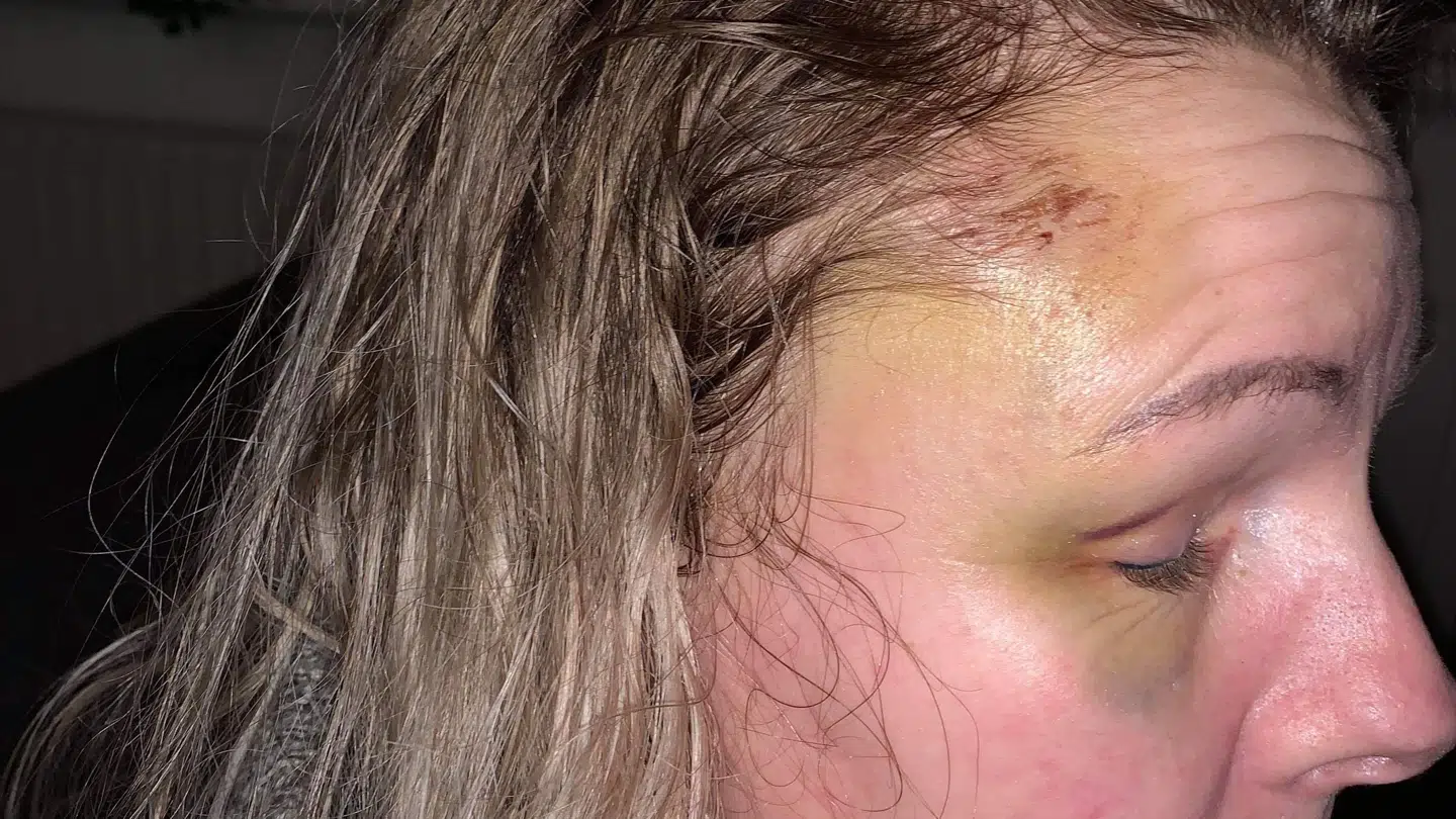 Rosa Lina Kailuweit som hun ser ud 14 dage efter overfaldet.