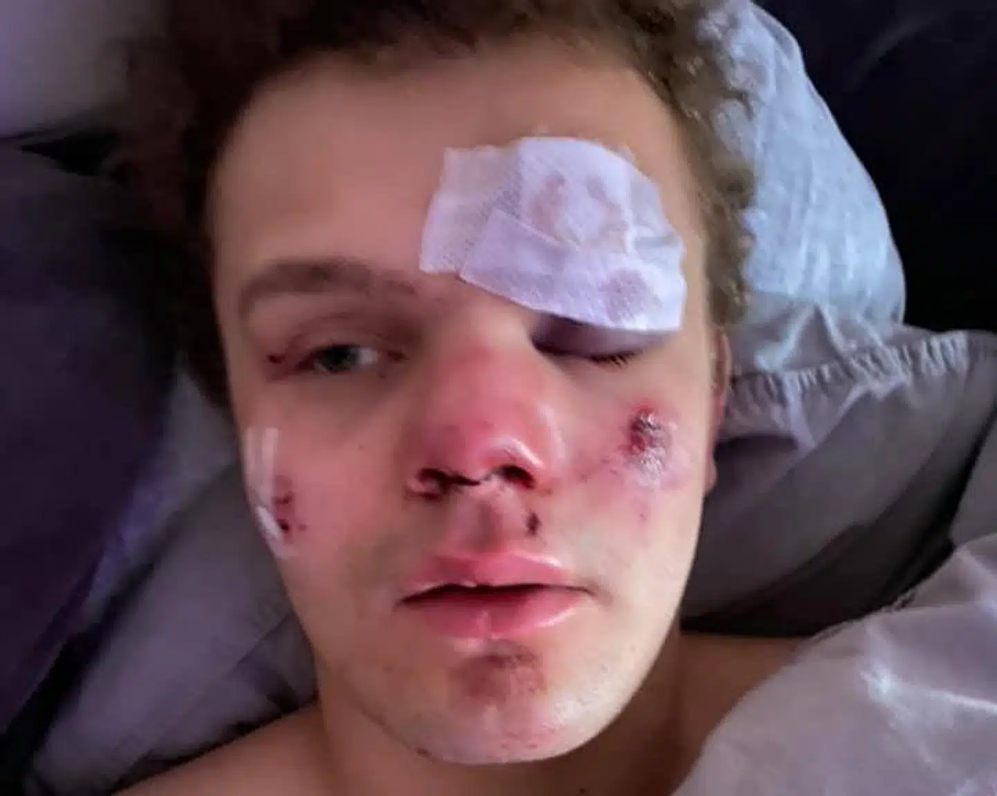 Sådan ser Lauritz Lindboe Wind ud, efter at han umotiveret blev overfaldet fredag aften i Gothersgade i København.