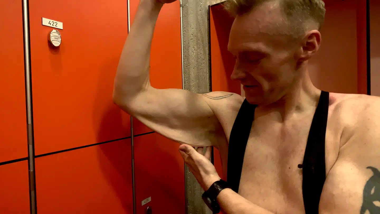 Store mængder løs hud er bagsiden af det store vægttab. Kaare Toft har allerede fået fjerne seks til otte kilo ud af små 20 kilo hud.