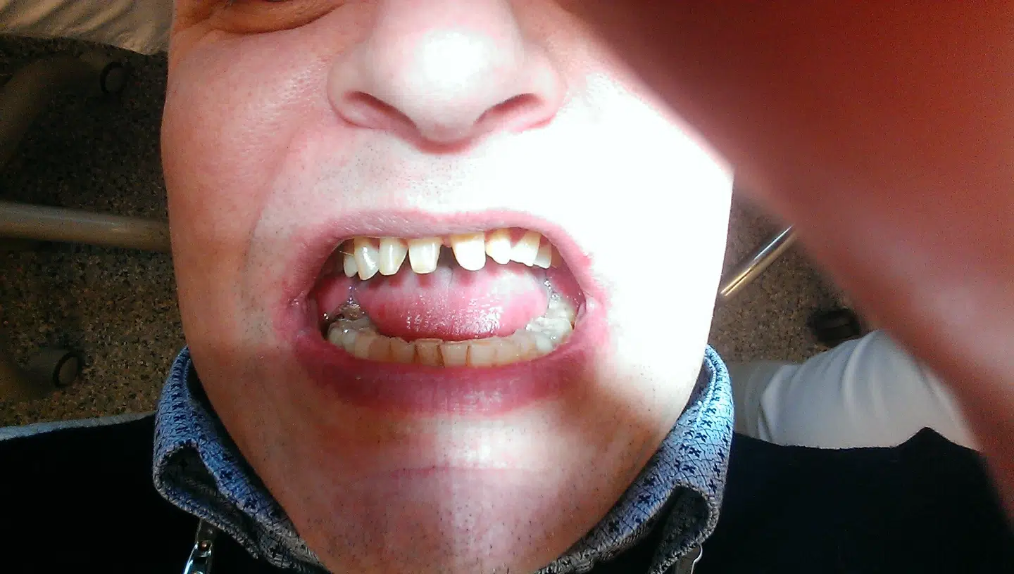 Henrik Sørensens tænder slebet ned under behandling