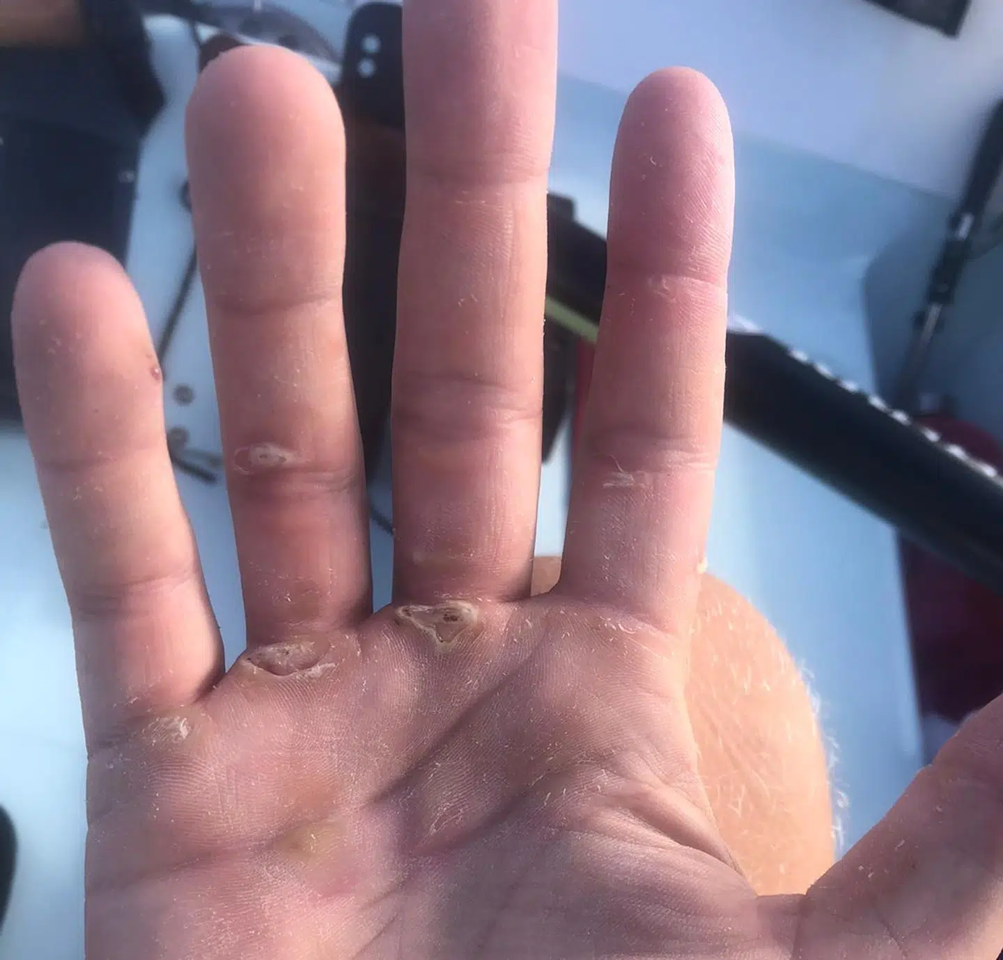 De mange timer med årer i hænderne, giver både vabler og en giglignende følelse i fingrene. Dett er Lasse Wulff Hanses hånd efter cirka to uger på vandet.