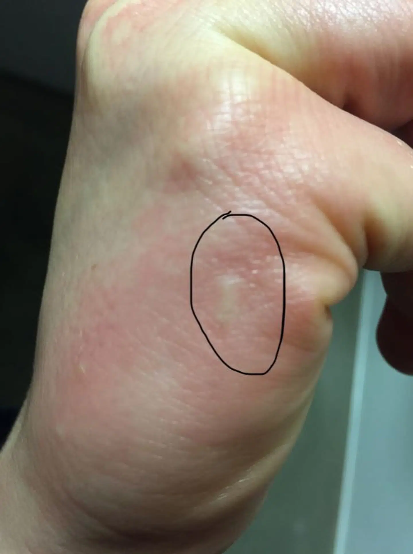 Fnatmiderne graver gange under huden. På billedet kan du se en af de midegange, som Ida har fundet på sin hånd.