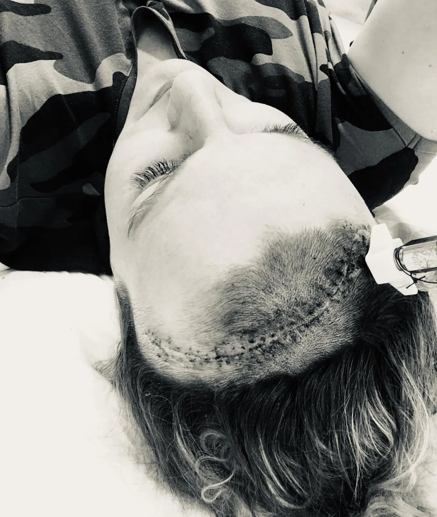Det var nødvendigt for lægerne at skære Maria Pedersens hoved op, da hun skulle opereres.