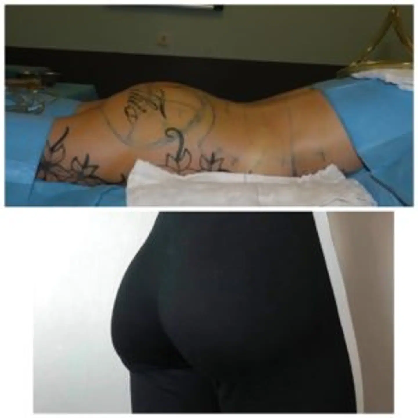 Før og efter Sashas BBL-operation. Foto: Privat