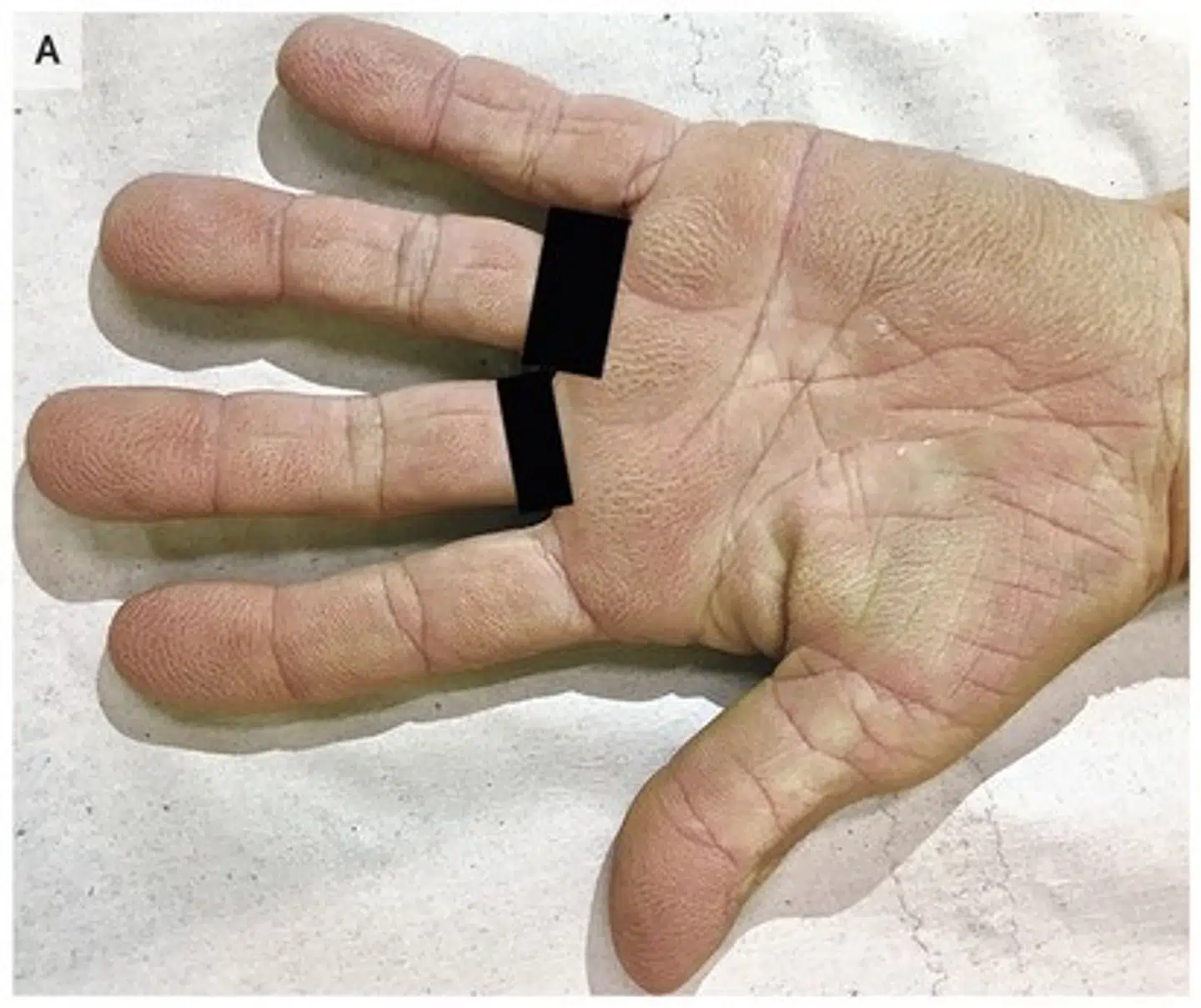 På billedet kan du se, hvordan kvindens hånd er præget af helt tydelige mønstrer.