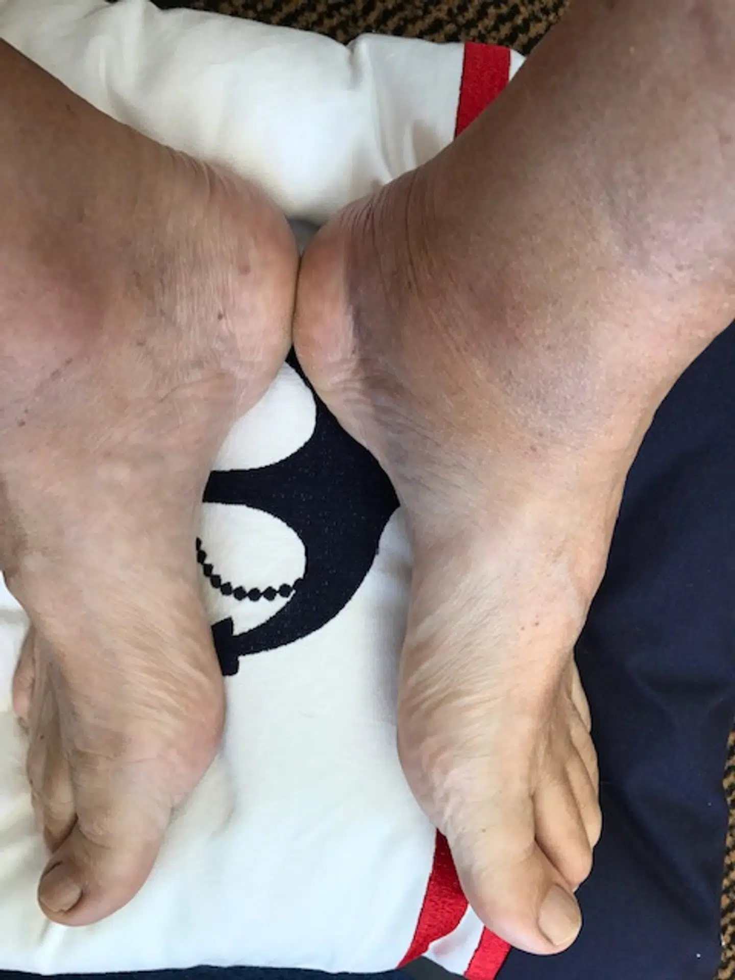 Billede af Max Tranebæks venstre fod, der blevet slemt skadet efter 23-åriges smækken med bildør. Foto: Privat.