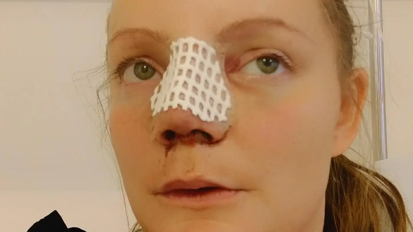 Linette vil ikke opereres mere på sin næse, men vil hellere leve med en næse, som hun er lidt utilfreds med. (Privatfoto)