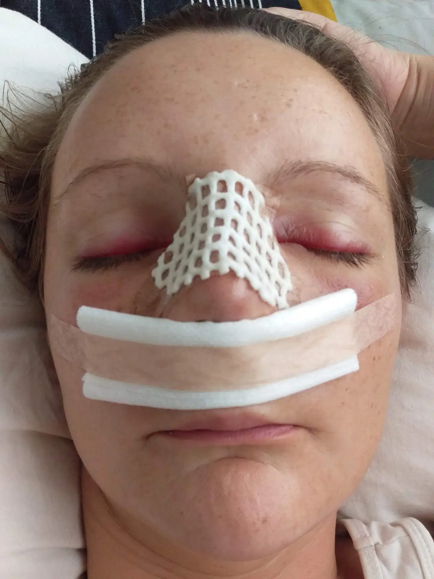 Linette beskriver sine næseoperationer som 'ekstremt smertefulde'. I dagene efter kan hun ikke trække vejret ordentligt, og oplever smerter i hele hovedet og helt ned i halsen. (Privatfoto)