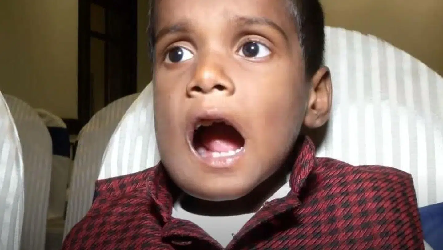 tandlæger i Indien fandt 526 tænder i munden på en 7-årig dreng, der havde ondt i kæben.