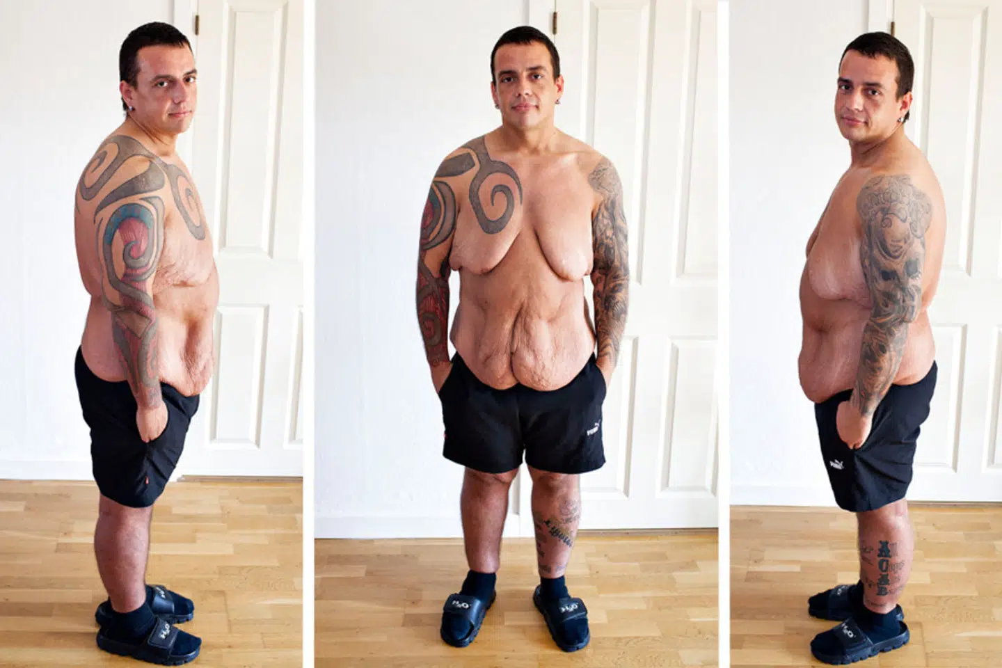 Jesper Skovshoved tabte 140 kilo, og drømmer stadigvæk om, at få fjernet løst hud fra kroppen.