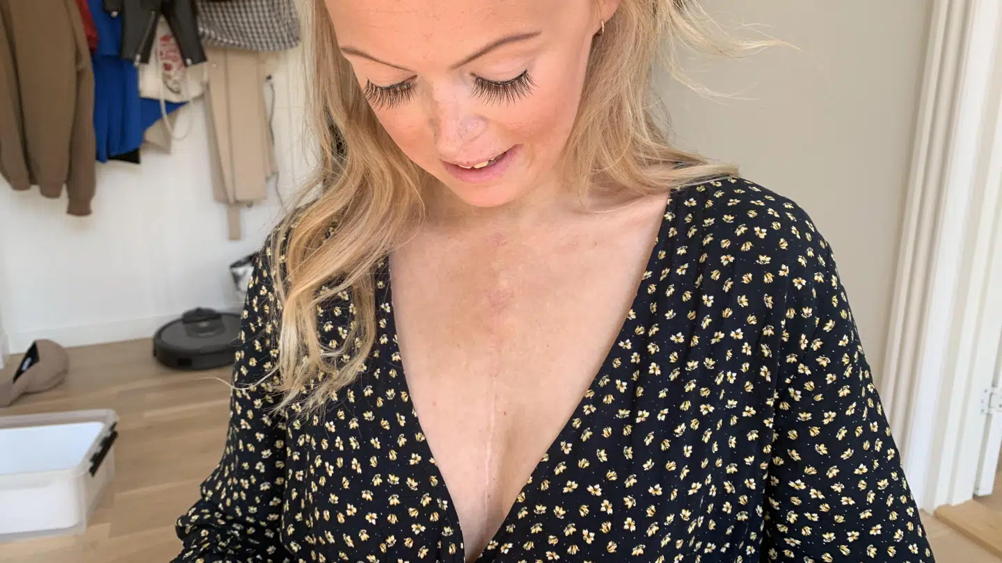 Cecilia har fået et stort ar efter den vellykkede operation. Foto: Camilla Bøgeholt Lund.