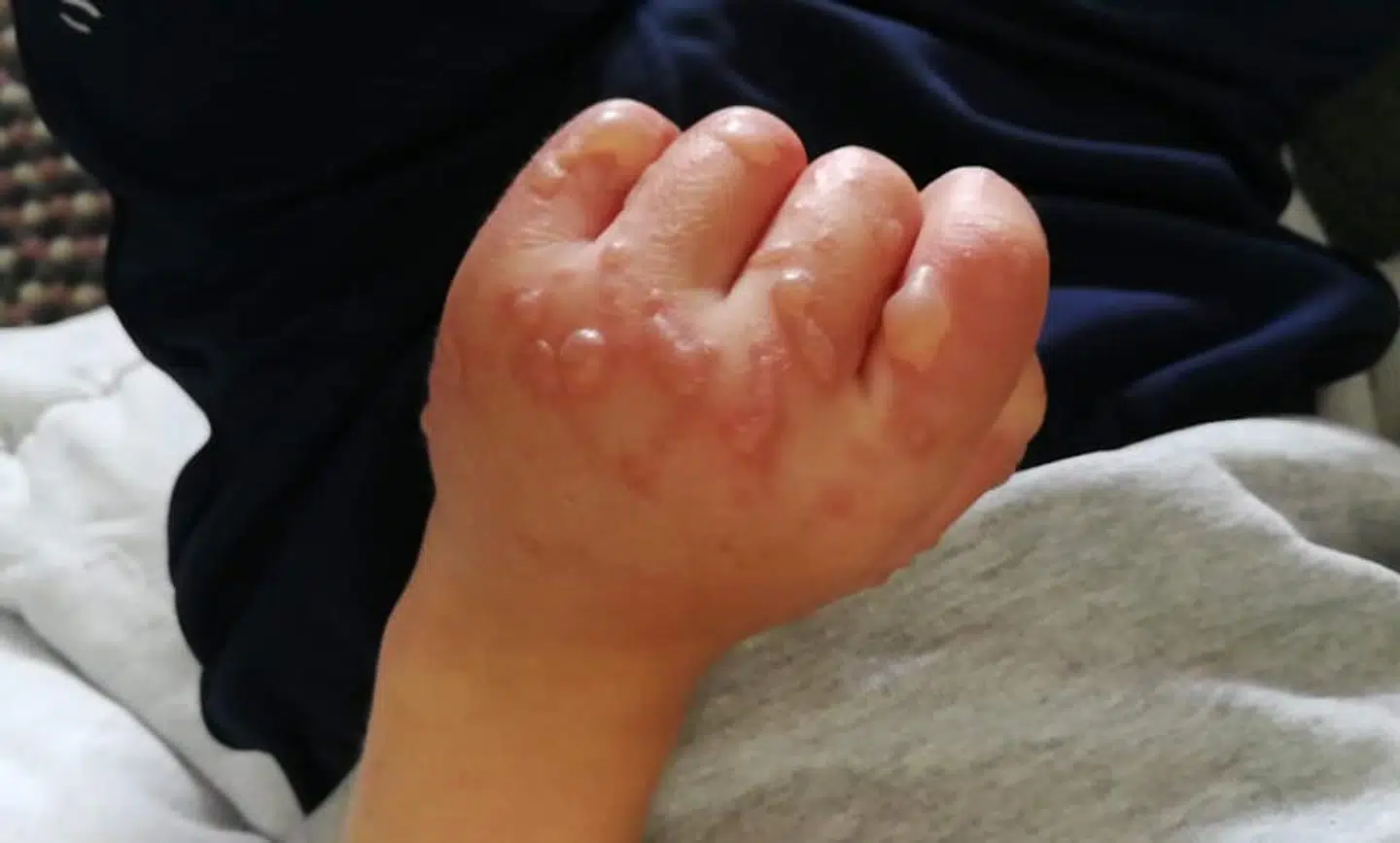Den ene dreng fik store, smertefulde blærer på kroppen, herunder hånden som det ses her. Billede er bragt med samtykke fra forælder. Privatfoto
