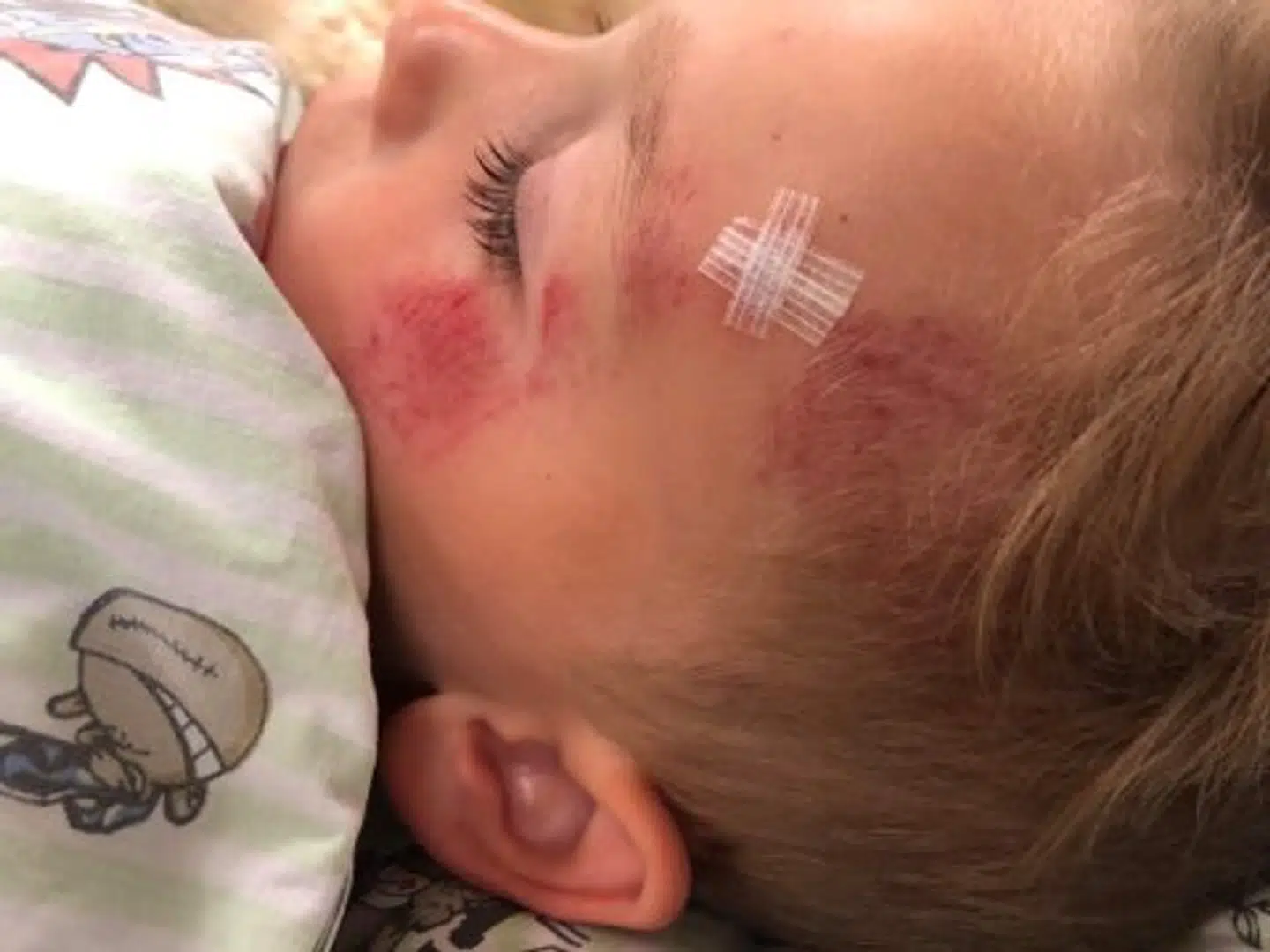 Store dele af fem-årige Emils venstre side er mærket med rifter og sår.