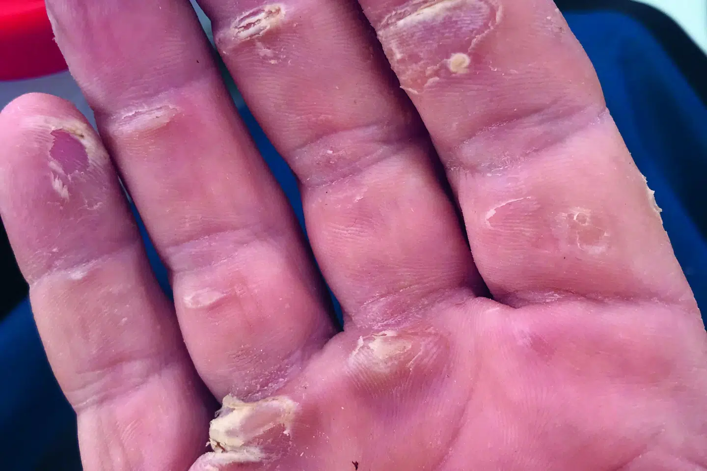 Sådan så Mads Vangsøs hånd ud, efter at have roet de første par uger.