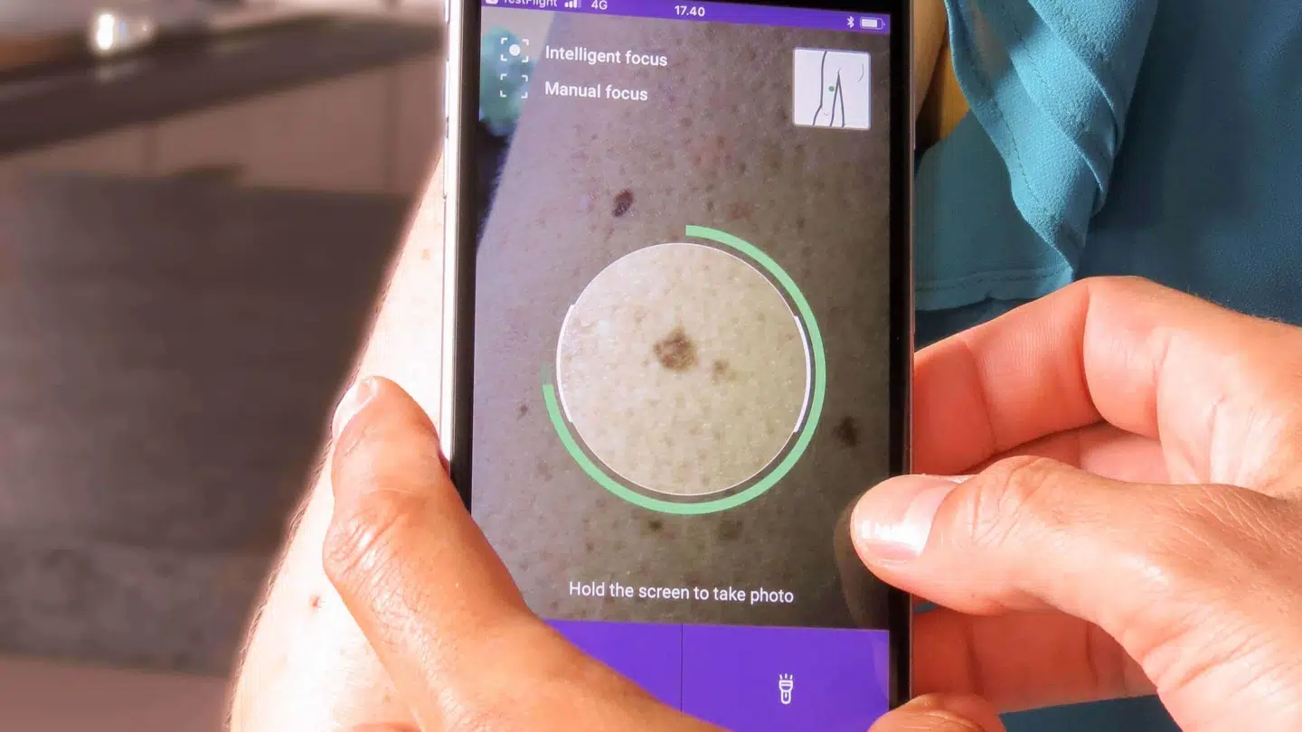 Med app'en Miiskin kan du som Nanna tjekke og holde øje med dine modermærker. Foto: Miiskin.