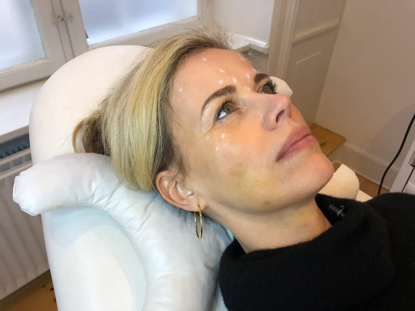 Min navn det står med prikker ... Her er jeg på Cerix klinikken og har fået tegnet prikker før botox indsprøjtninger - læg mærke til hvor gul og blå jeg stadig er efter min Ulthera behandling.