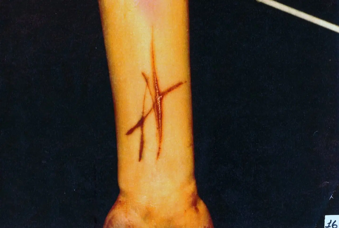 Stine Geisler døde 2. pinsedag 1990 få dage før sin studentereksamen. Hendes morder er aldrig fundet. Historien om mordet på Stine Geisler er en ond historie uden håb og forløsning. Der er ingen opklaring for enden af teksten. Her nærbillede af Stine Geislers højre underarms inderside med bogstavlignende overfladiske snitsår, uden såkaldt vital reaktion (ingen blodudtrædning).