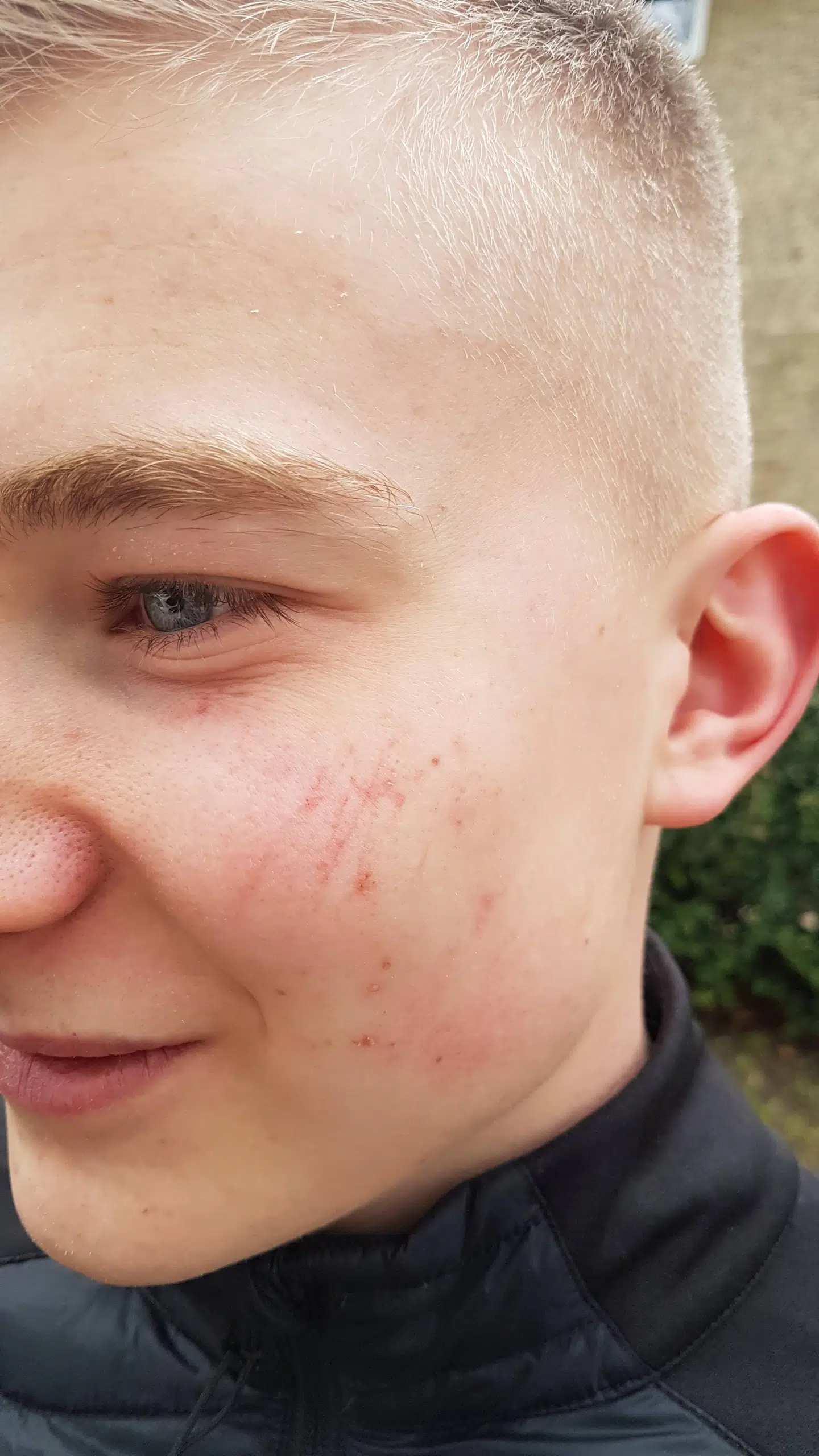 17-årige Victor efter overfaldet.
