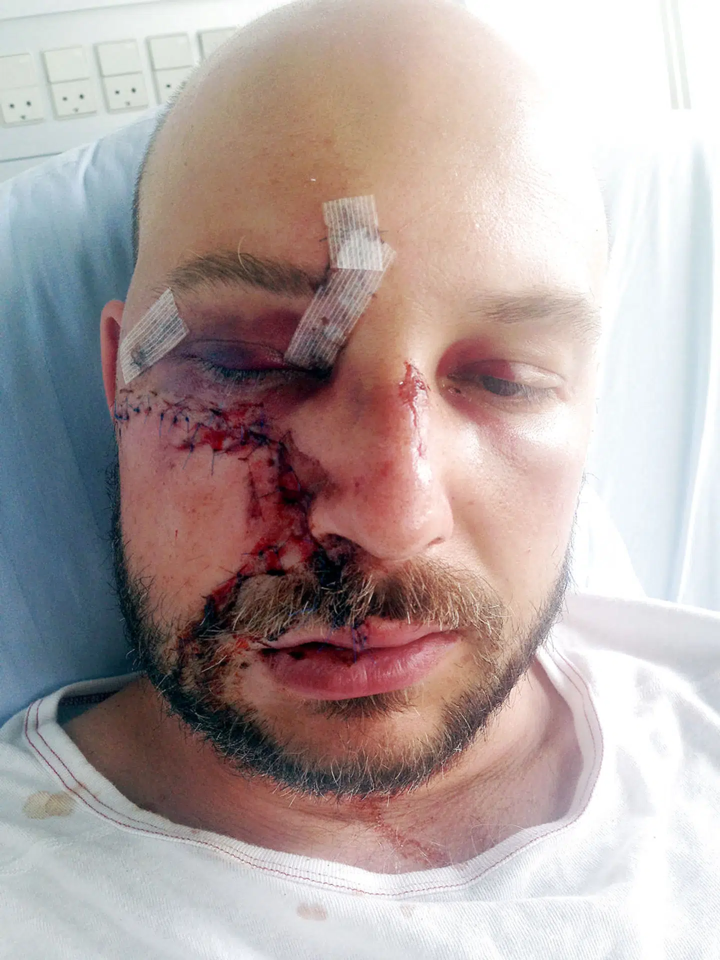 Her er privatfoto af tv-kokken Thomas Castberg, efter han kom alvorligt til skade i en mountainbikeulykke i 2014.