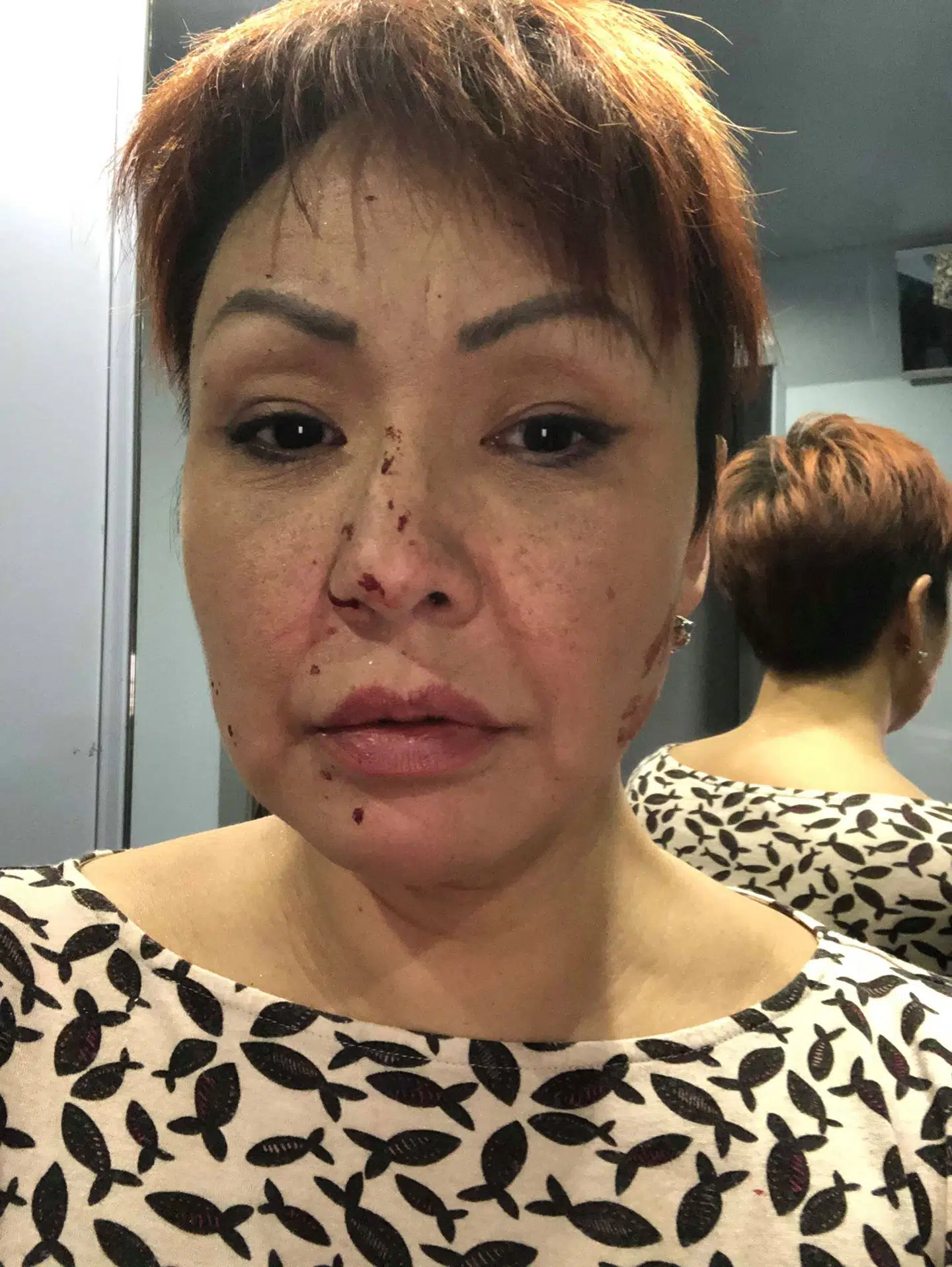 Inge Lennart tog dette billede af sig selv efter ulykken.