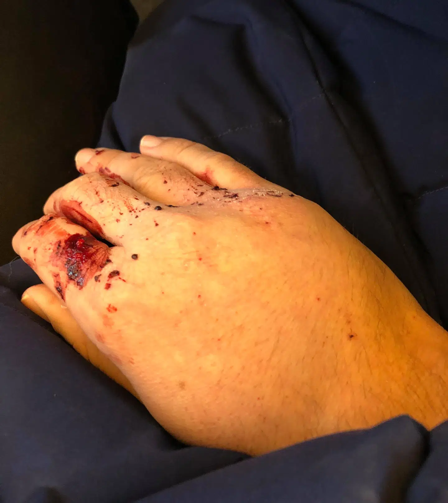 Jonas Dam brækkede hånden i onsdagens togulykke. Dette billede er taget umiddelbart efter ulykken i toget.