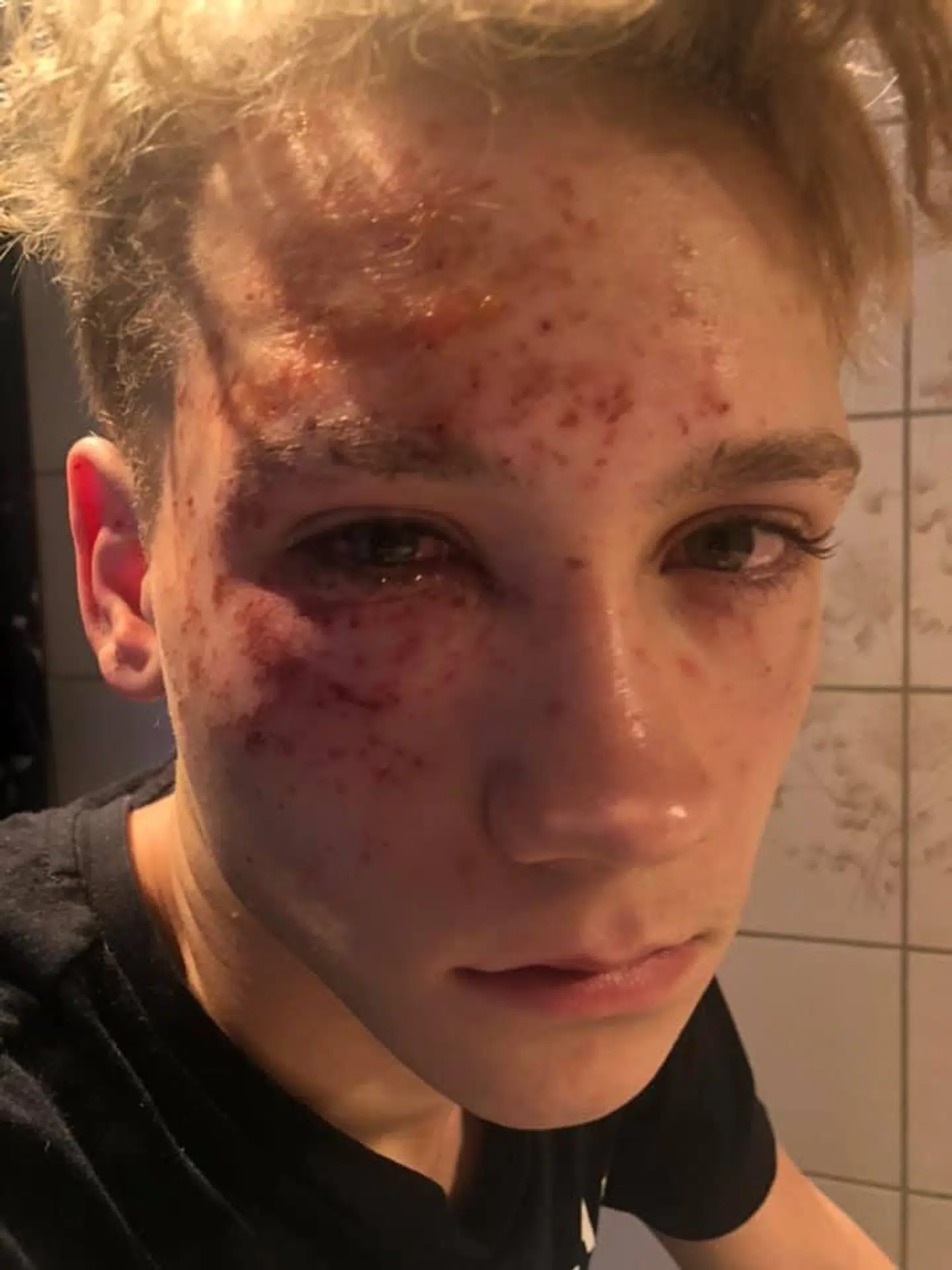 Mandag aften eksploderede et stykke fyrværkeri lige ved Markus ansigt. I dag siger han, at han aldrig vil tæt på fyrværkeri igen. Selvom han slap med mindre fysiske skader, fortæller hans mor, at han stadig er meget påvirket af ulykken mentalt.