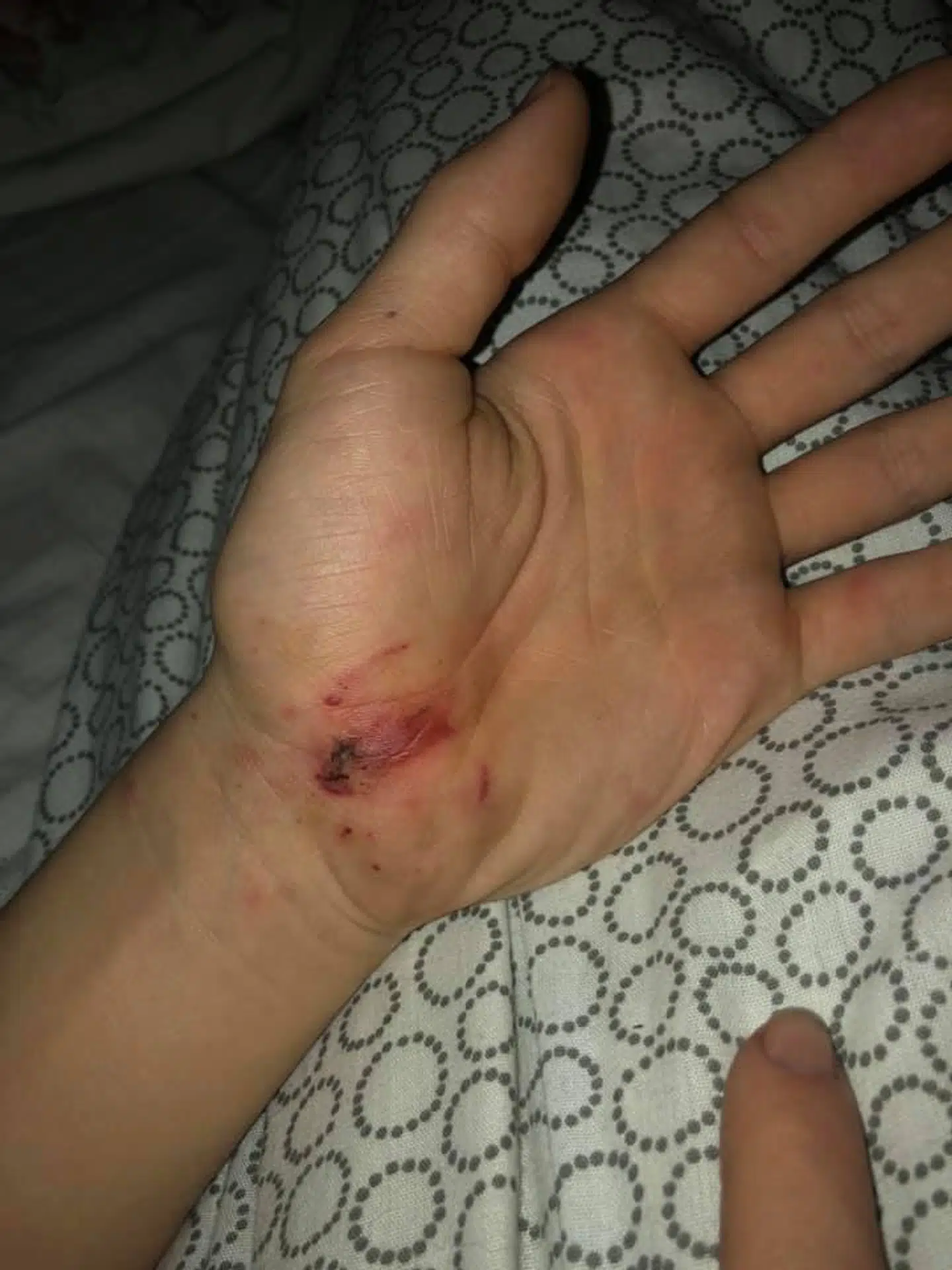 Markus greb om fyrværkeriet, da det sprang. Lægerne siger derfor, at han er utrolig heldig, at han ikke mistede sine fingre. Han har dog flere smertefulde blodvabler efter ulykken.