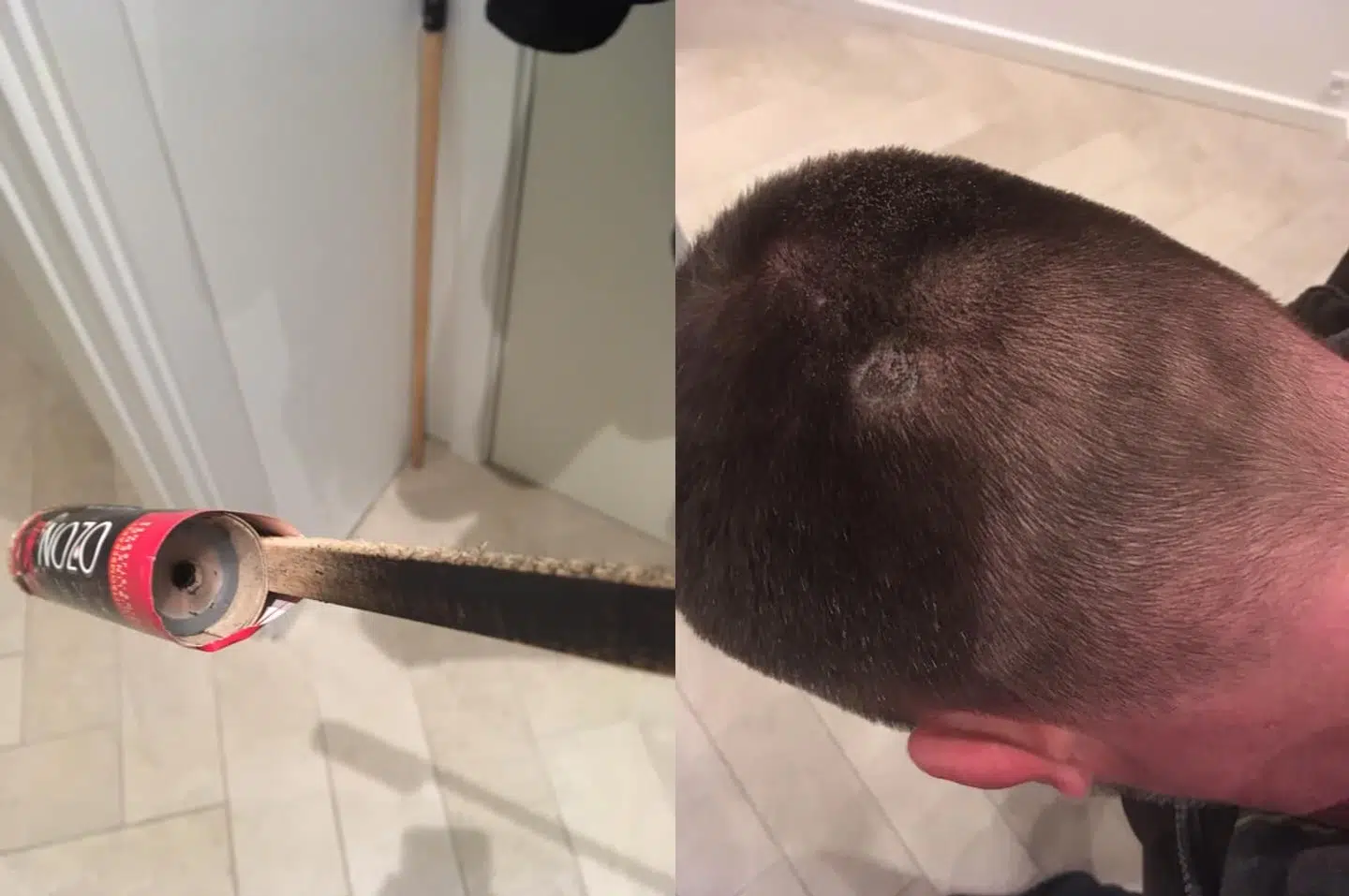 Jack viser på Facebook, hvordan hans baghovede blev ramt af raketten.