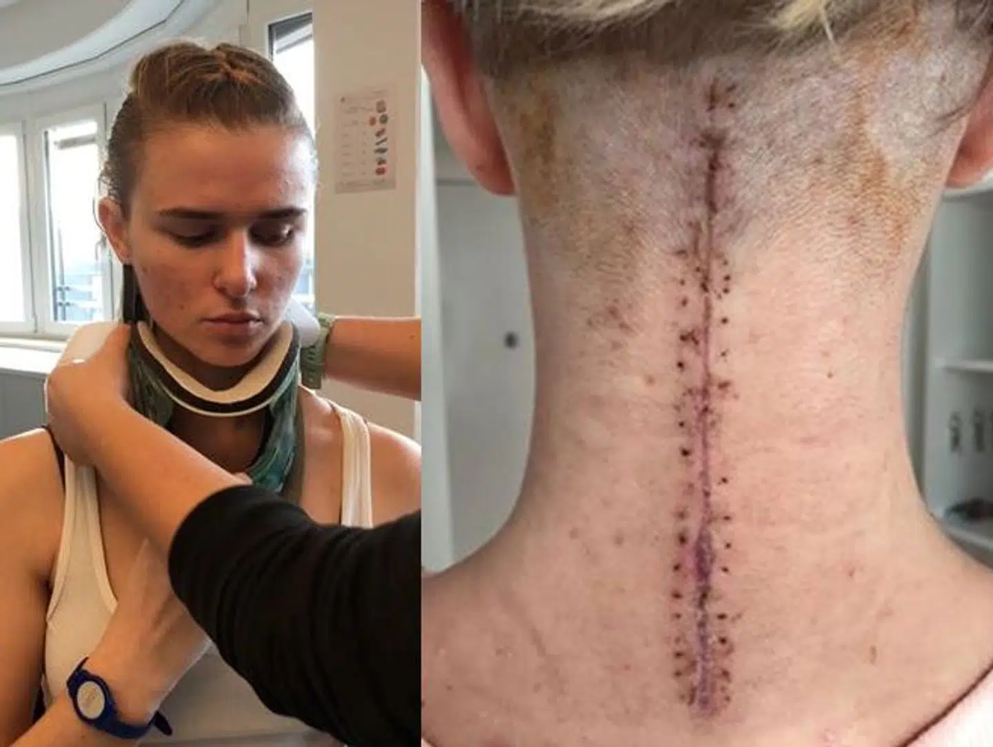 Tetiana Korenieva fik for nyligt halskraven af i nogle få minutter. Hun har haft kraven på siden 1. august, hvor hun styrtede ned under en optræden i Cirkus Arena