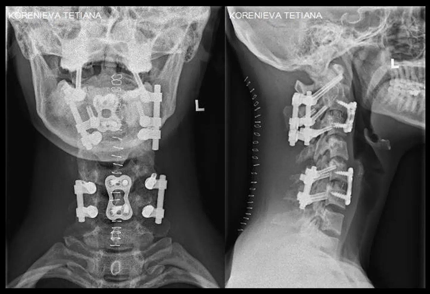Et røngtenfoto viser de implantater, lægerne i Hamburg har opereret ind i nakken på Tetiana Korenieva. Der er tale om 18 skruer, fire metalstænger og to metalplader.