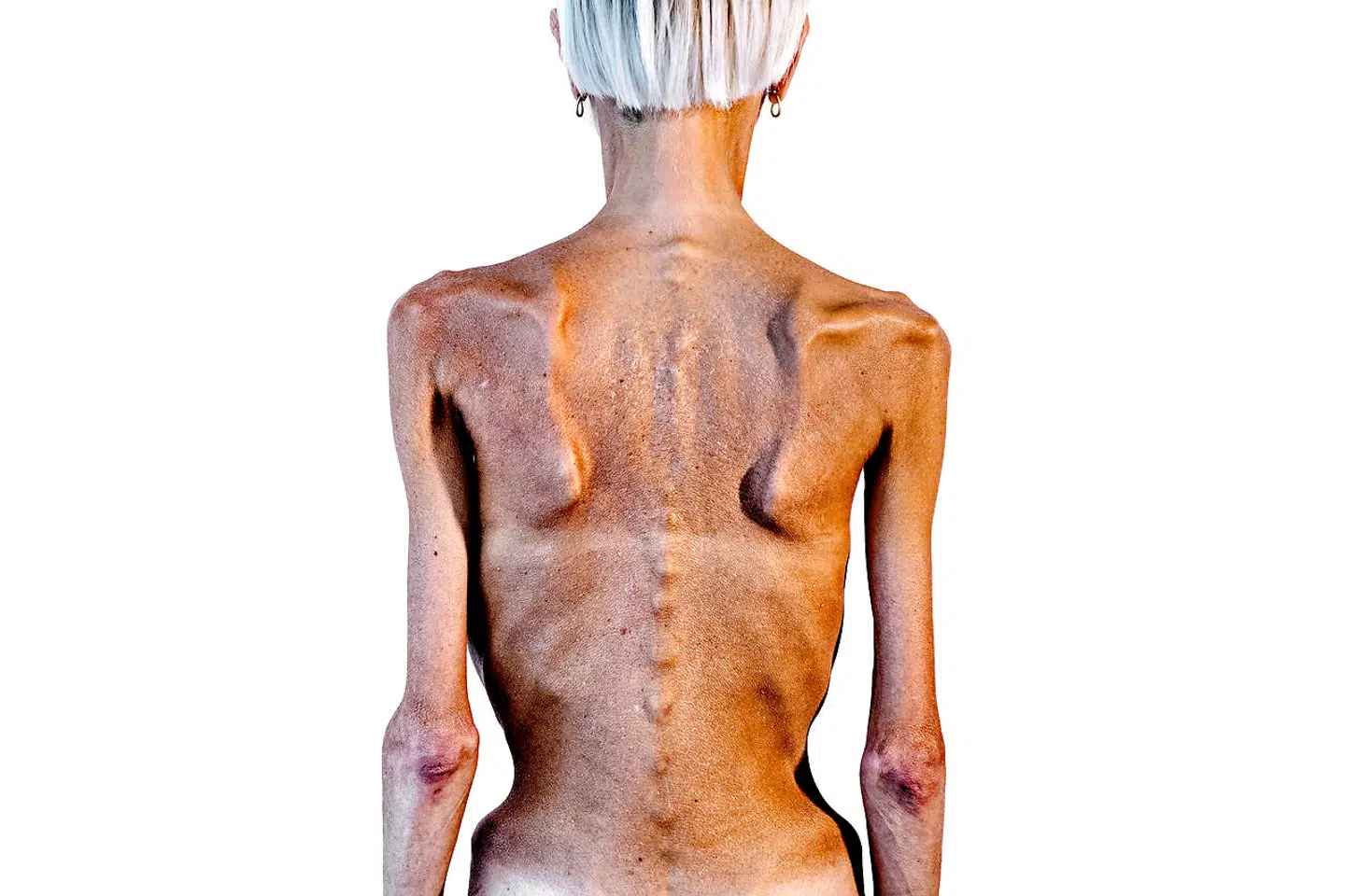 AnorekSigne med det borgerlige navn Signe Grønnebæk har lidt af en alvorlig spiseforstyrrelse i mere end 16 år. Hun har nu udgivet en bog om sit liv som spiseforstyrret.
