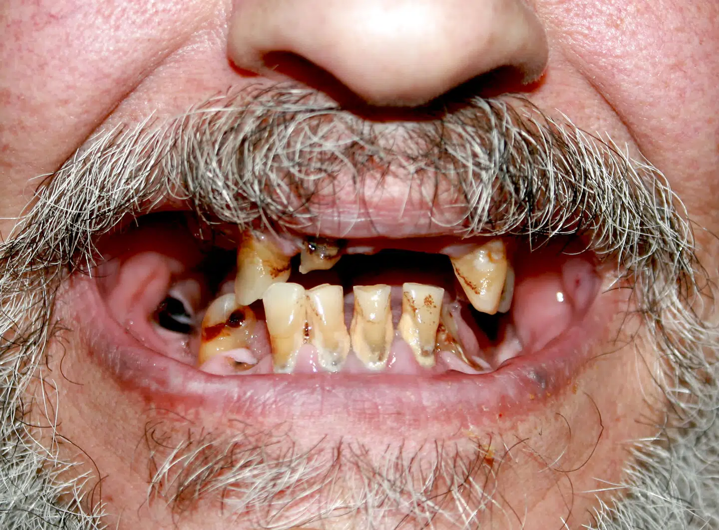 Når vi drømmer om at tabe tænderne, handler det som regel om forandringer i det vågne liv. (Modelfoto/Scanpix)