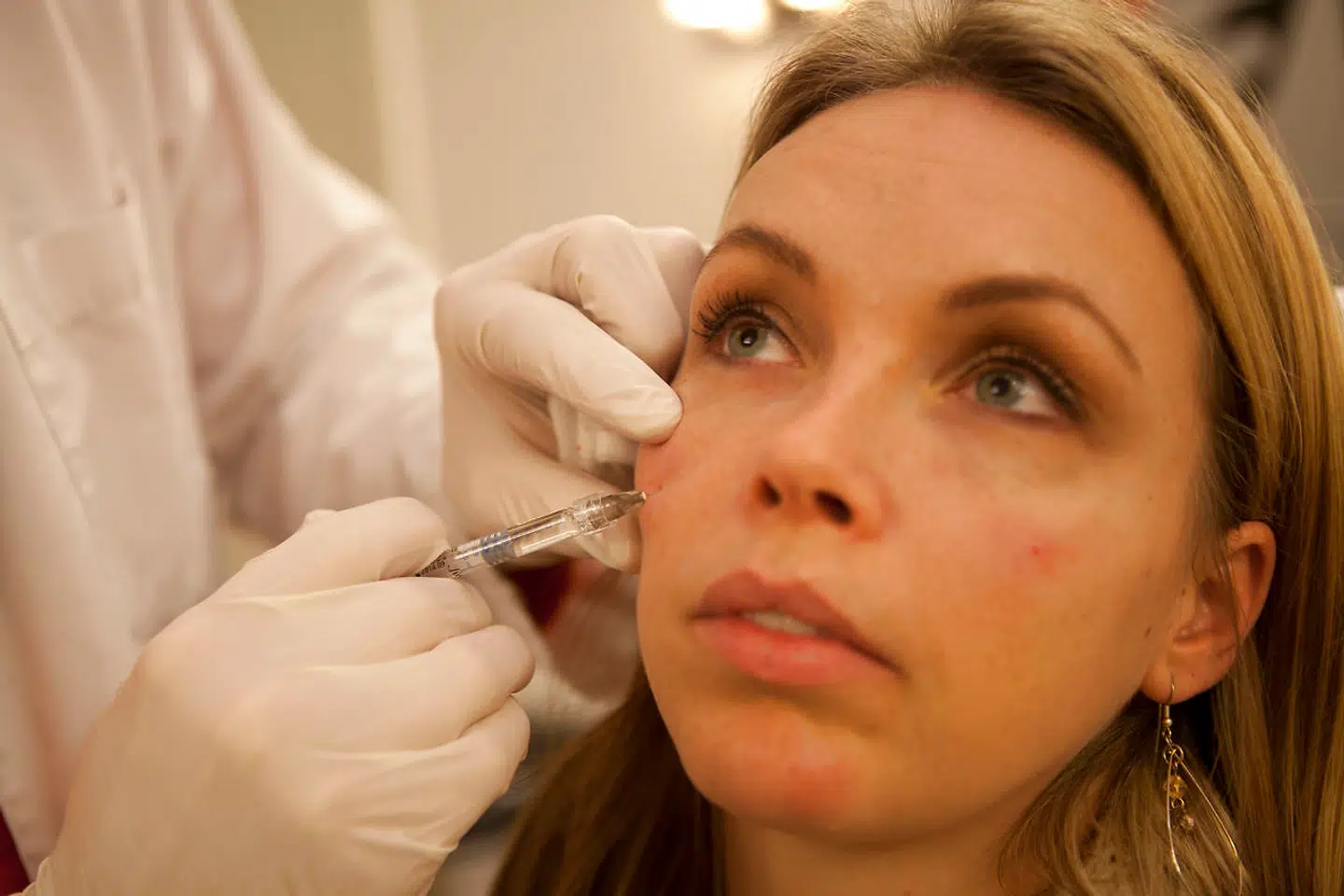 Arkivfoto Nina Nielsen, som får ordnet sine rander under øjnene og rynker mellem øjenbrynene på Klinik Qura.