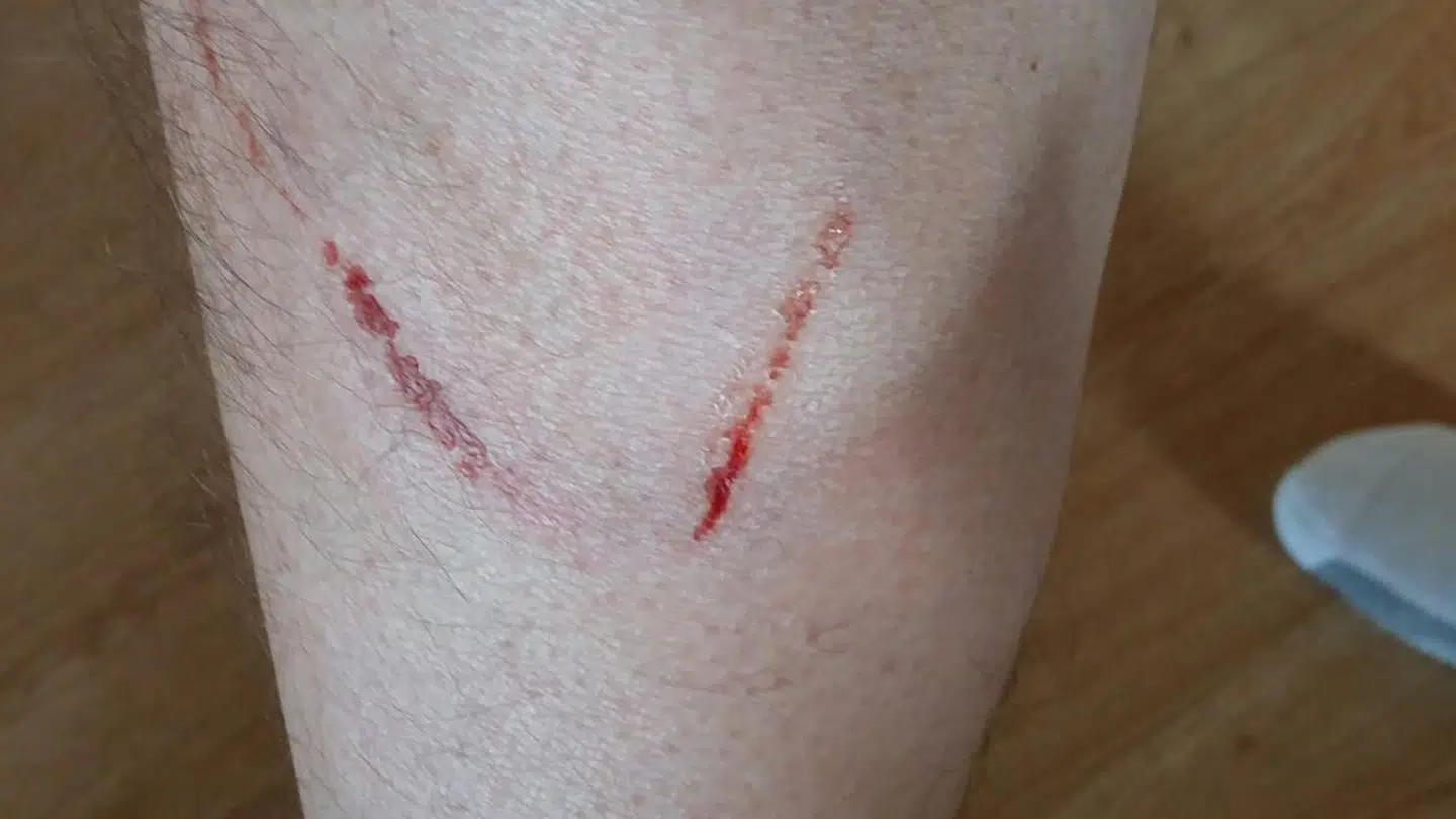 Christian Vindeløv Jensen blev angrebet af to hunde og bidt to gange under en cykeltur.