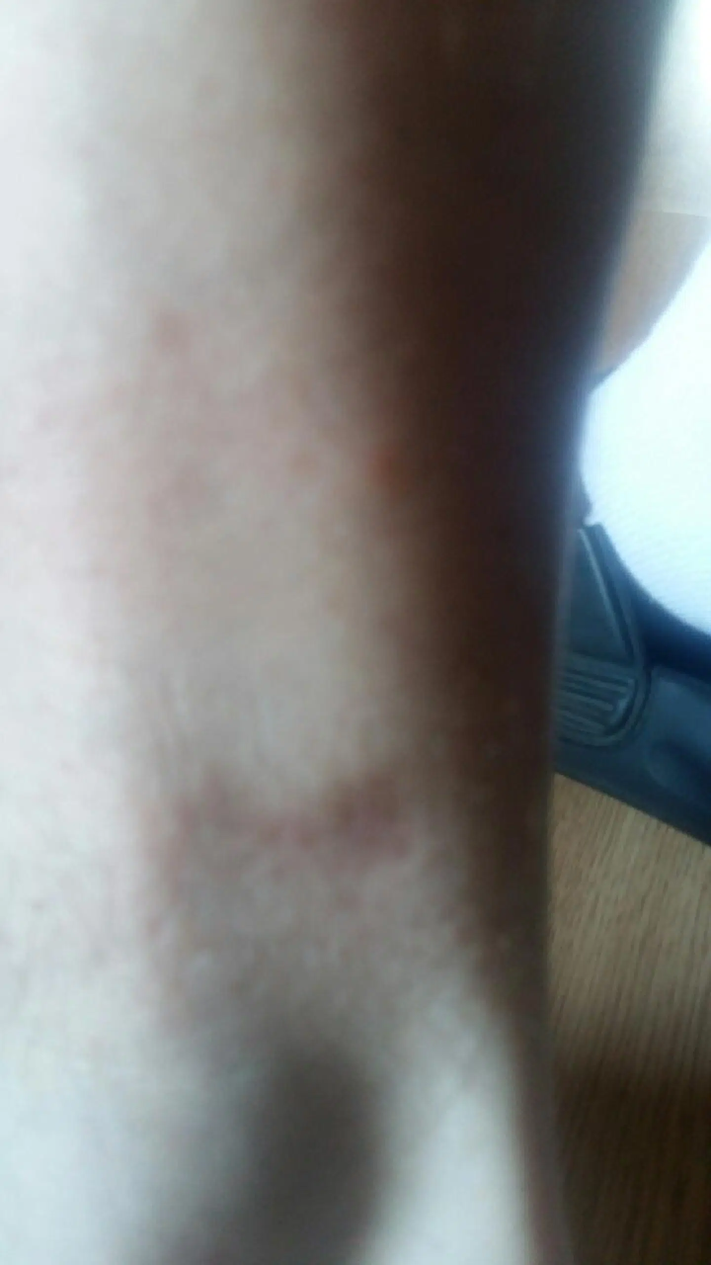 Sådan ser såret efter hundebiddet på Christians ankel ud i dag, mere end fire måneder efter angrebet.