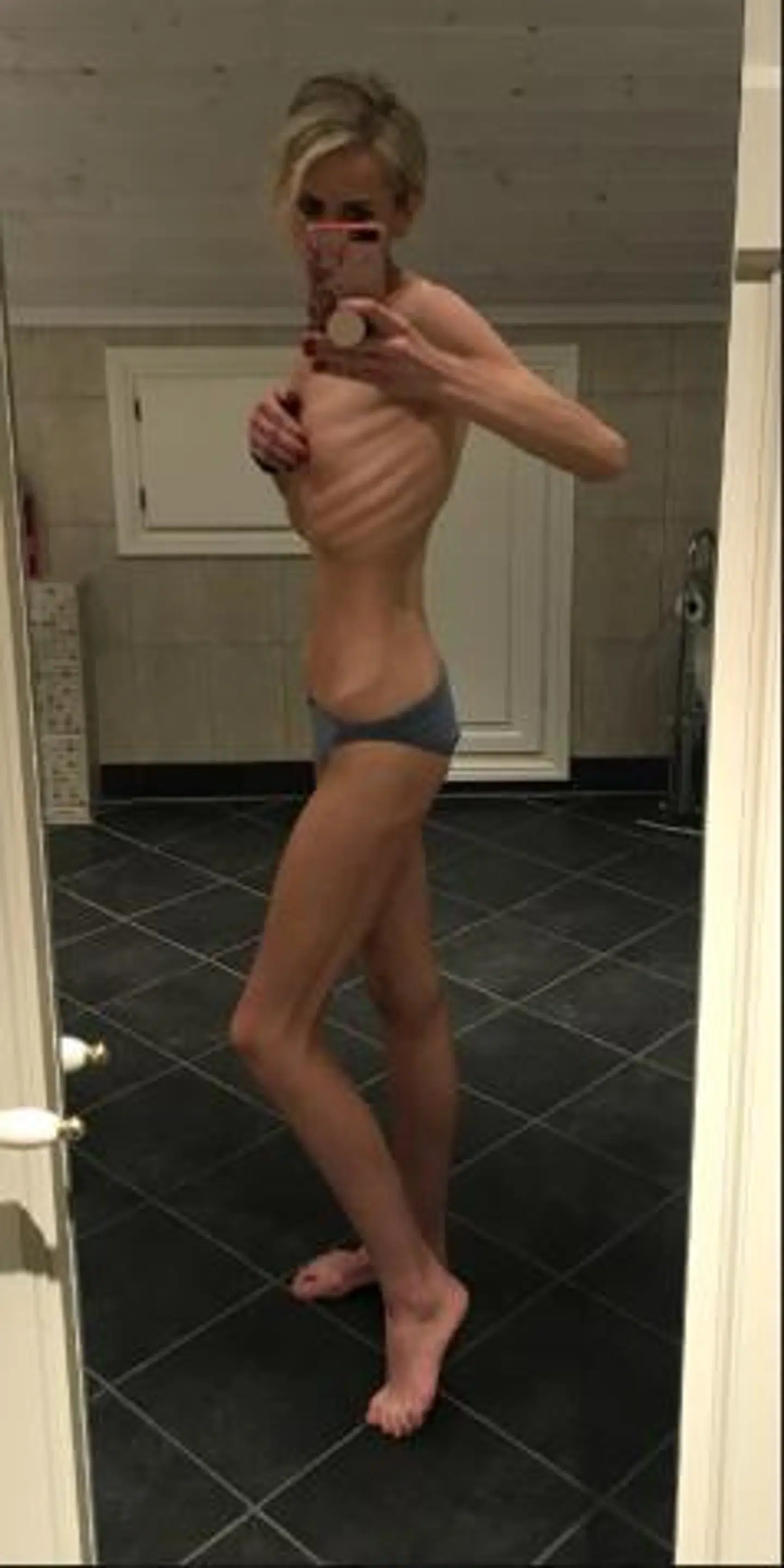 Et år efter fedmeoperationen havde Tina tabt 75 kilo. Hun blev diagnosticeret med anoreksi.