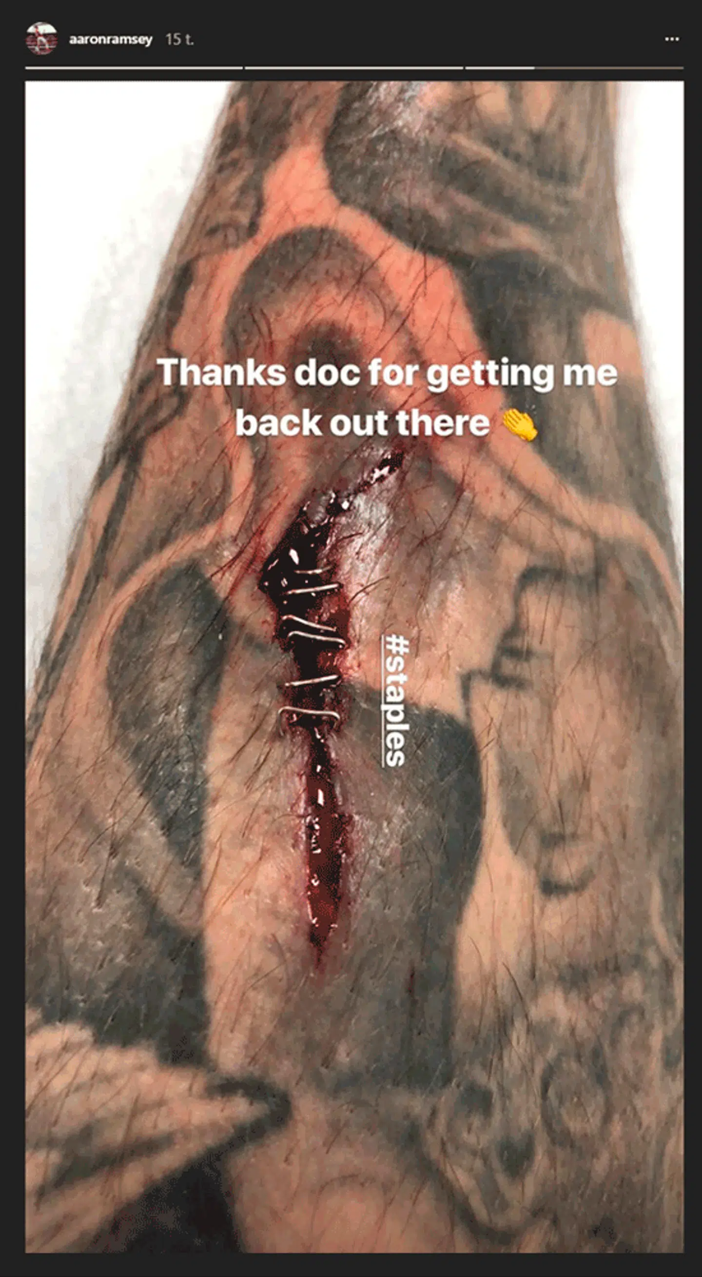 Her er den grusomme skade, som Arsenal-profilen Aaron Ramsey pådrog sig i torsdagens kvartfinale-kamp mod CSKA Moskva.