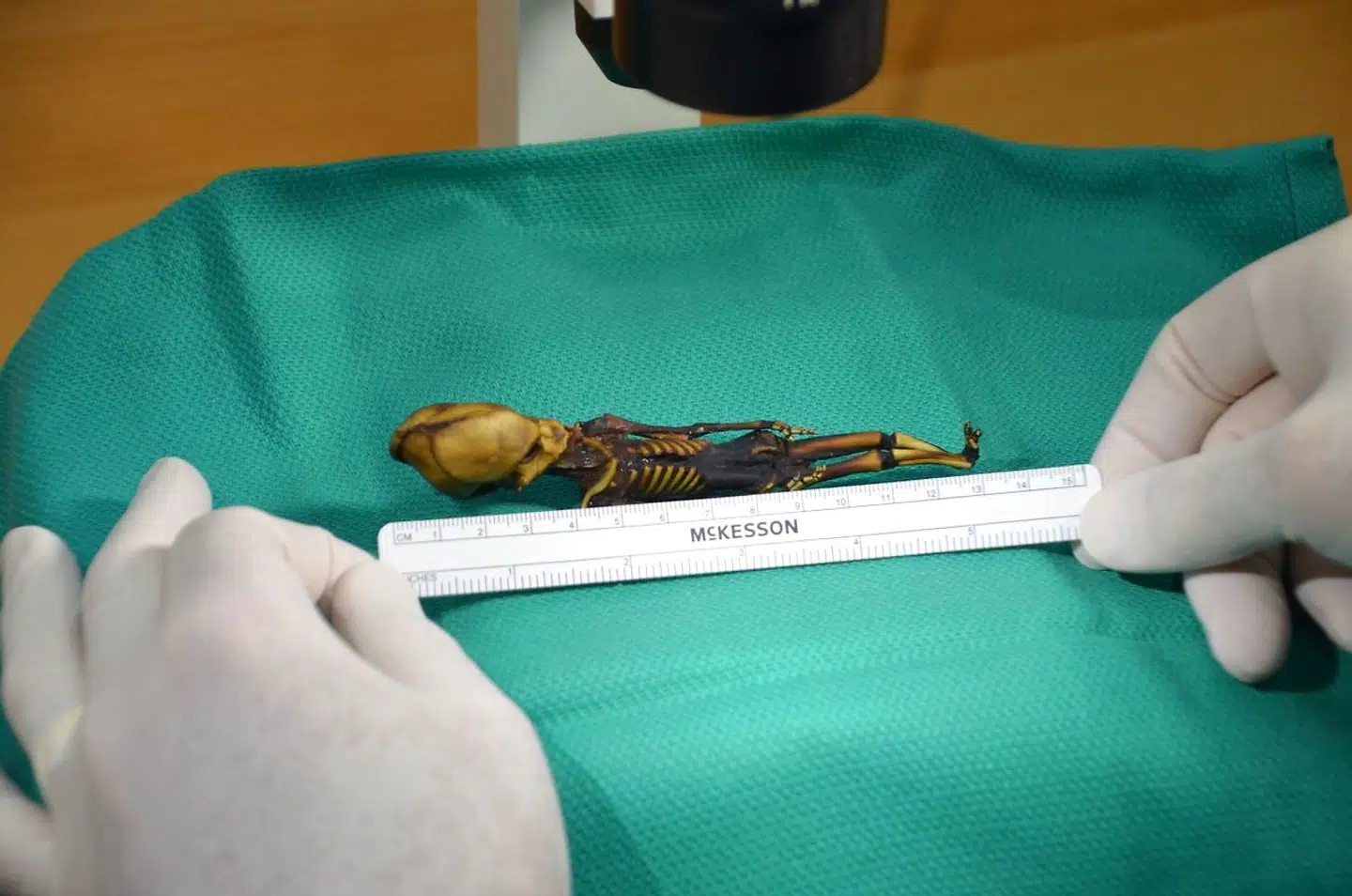 At liget skulle være udenjordisk blev afvist af forskere for lang tid siden, men nu har forskerne imidlertid afsløret, at den lille pige led af en række sjældne genmutationer.