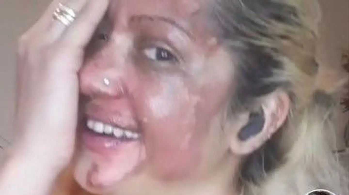 Sådan ser Shafia Bashirs ansigt ud efter hændelsen.