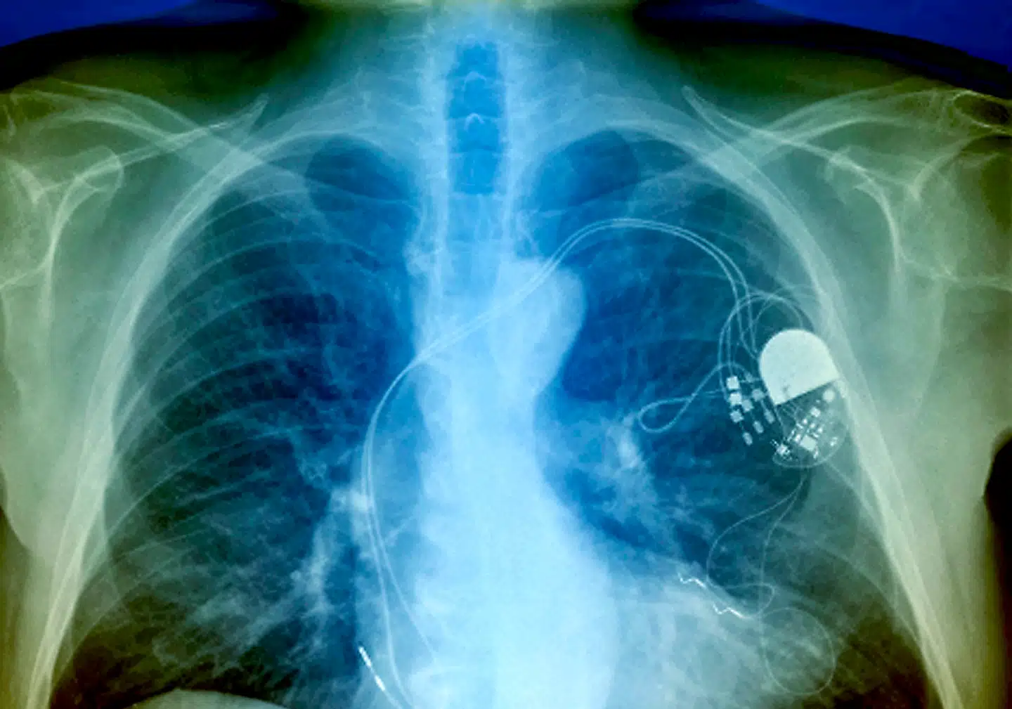 Selvom studiet blandt de første af slagsen, er det ikke første gang, teknologi viser sig at kunne have negative sundhedskonsekvenser.