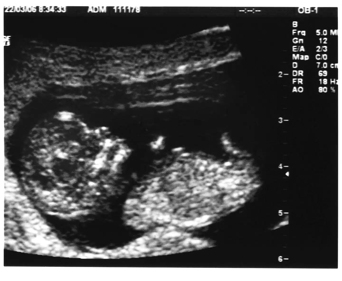 Scanningsbillede fra uge 15. På sundhed.dk kan man læse, at et foster i 22. uge er cirka 27 cm langt og vejer omtrent 450 gram. Hænder og fødder er blevet så stærke, at de er i stand til at gribe. Er det etisk forsvarligt at abortere det foster – også hvis det ikke fejler noget og kan holdes i live, hvis det blev født? spørger podcasten »Pilestræde« i dag.