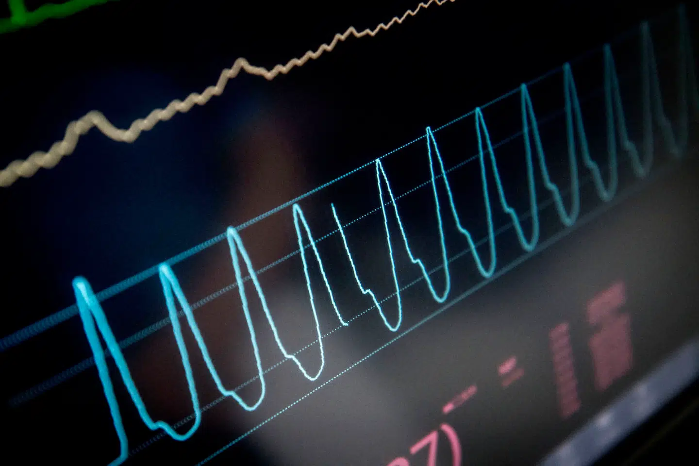 Ligesom arvelig kolesterolforhøjelse er forhøjet lipoprotein(a) hovedsageligt arveligt bestemt. Begge medfører svært forhøjet risiko for hjertesygdom, konkluderer ny dansk forskning.