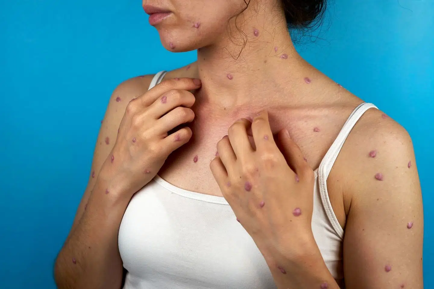 Den første kvinde i Danmark er smittet med abekopper. Det oplyser Sundhedsministeriet på sin hjemmeside. Det seneste døgn er der konstateret fem nye smittede (arkivfoto).