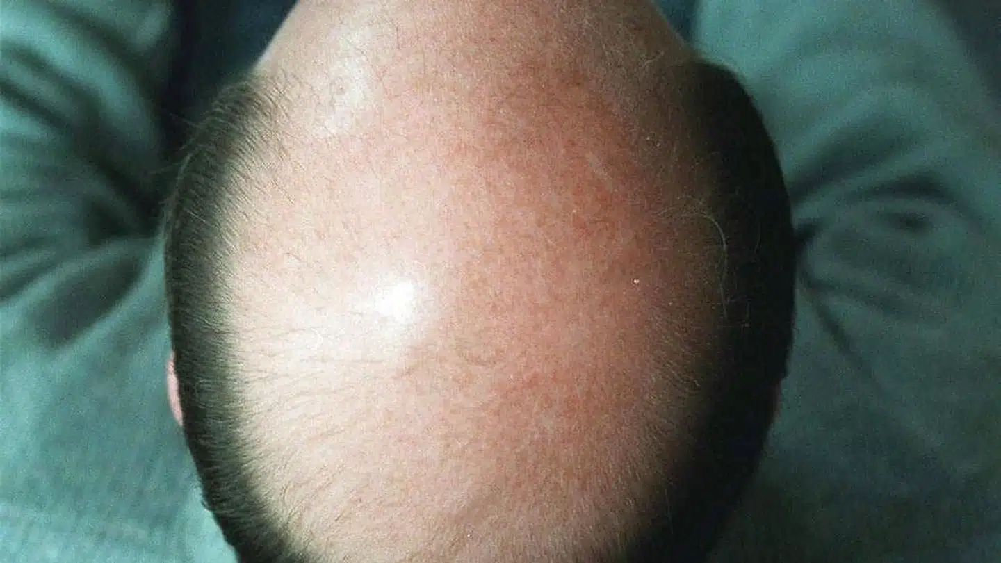 Forskning i proteiners rolle for sårheling har vist sig at kunne få betydning for behandling af skaledethed hos mænd.