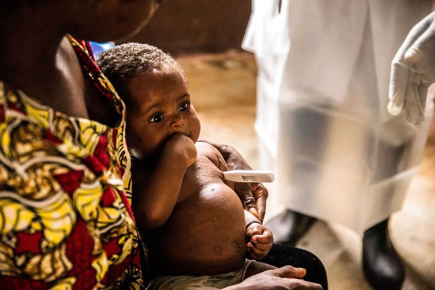 I det centrale Afrika har man årtiers erfaring med abekopper, og små børn er i særlig fare for et alvorligt forløb. Nu er verden vidne til det første større udbrud af sygdommen uden for Afrika, men en ny pandemi får vi næppe.